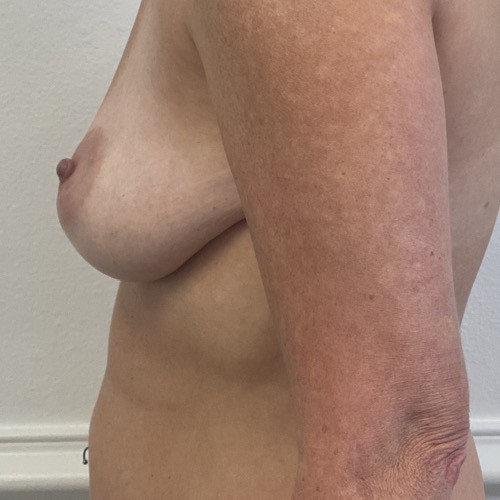 Breast Augmentation Left Before