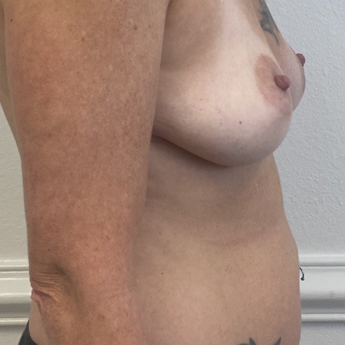 Breast Augmentation Right Before