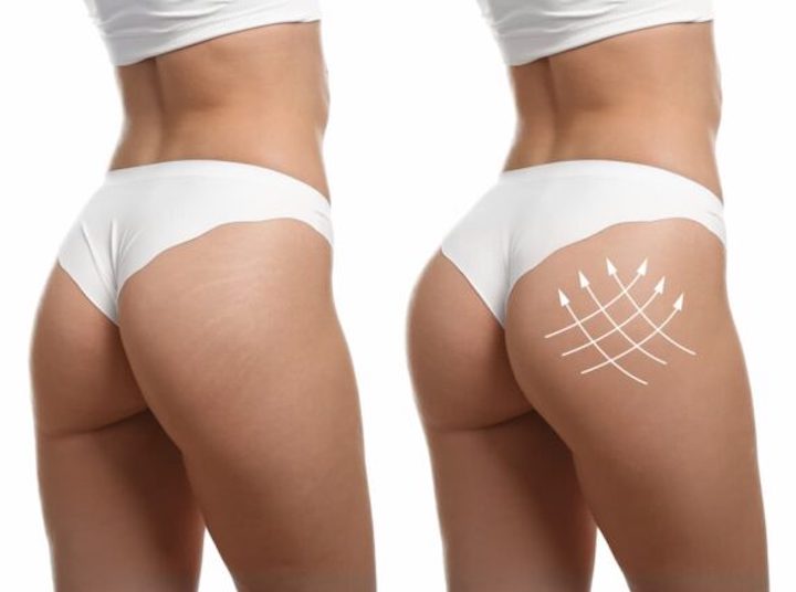 buttock augmentation brazillian butt lift tampa fl