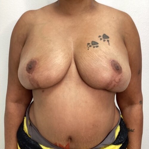 Breast Reduction Middle After