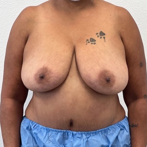 Breast Reduction Middle Before