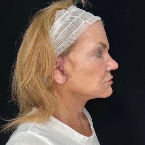 Facelift Right After