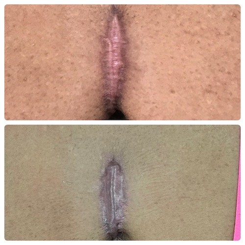 keloid before and after 2