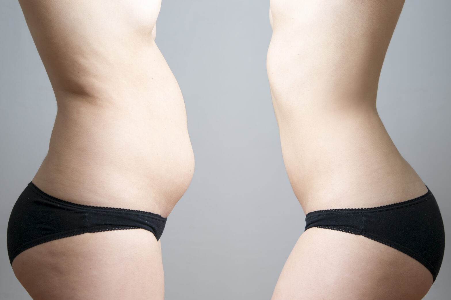 Featured image for post: What to Expect Before and After Liposuction Surgery
