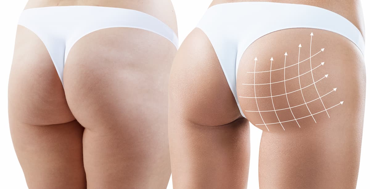 Featured image for post: The Difference Between Butt Implants vs BBL (Brazilian Butt Lift)
