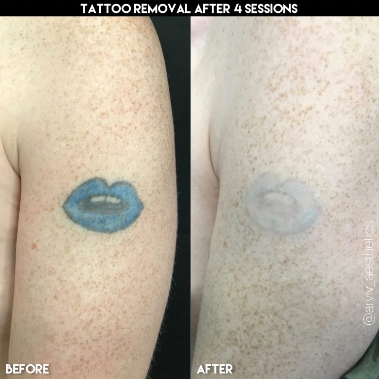 tatuaje antes y después 2 laser tattoo before and after 3