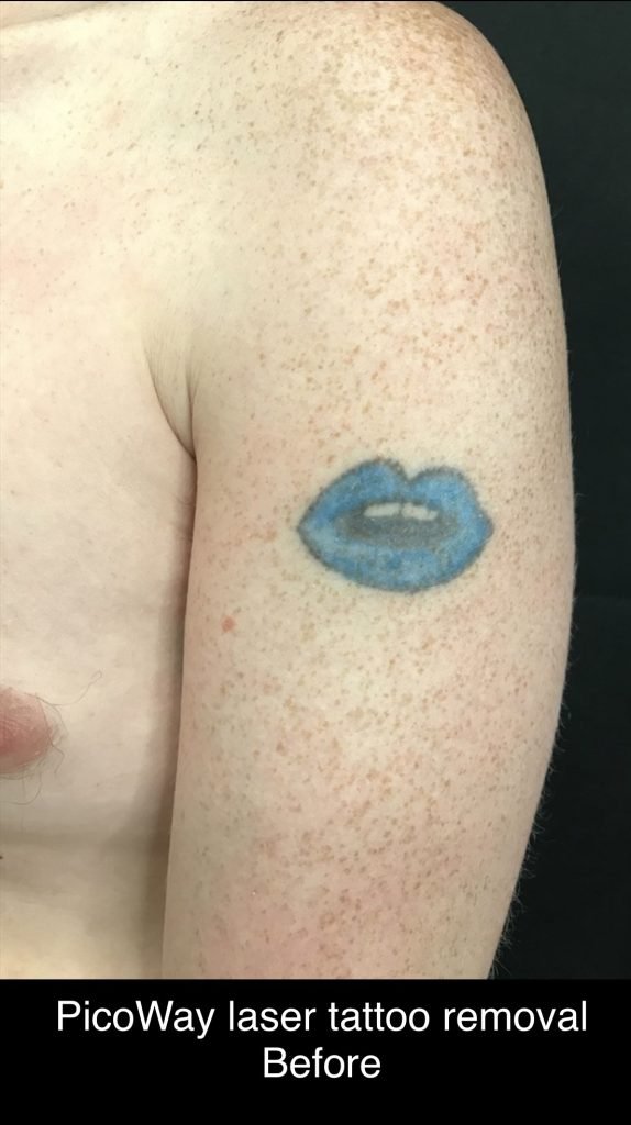 Lipedema 1 laser tattoo before and after 4