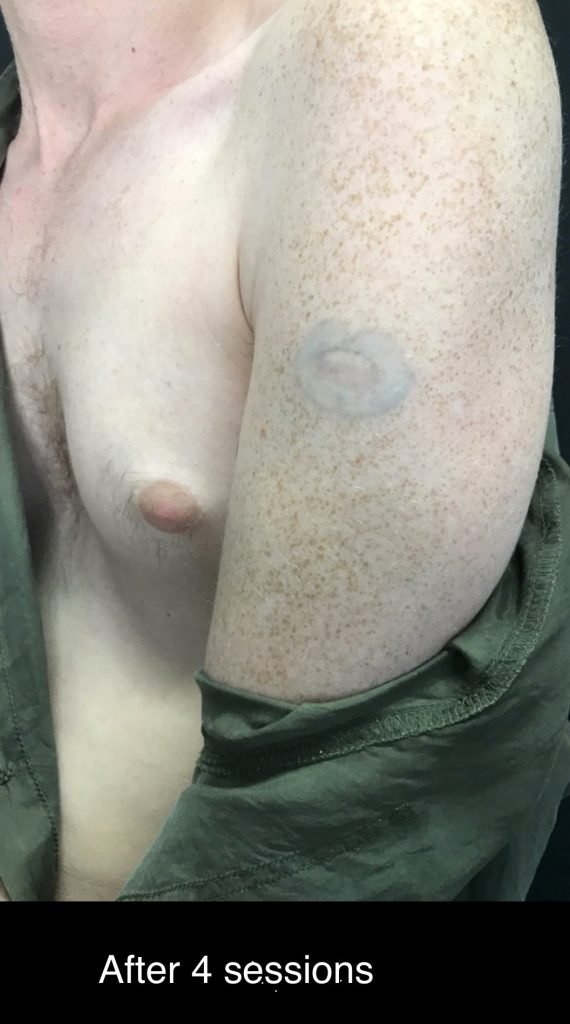 Lipedema 2 laser tattoo before and after 5