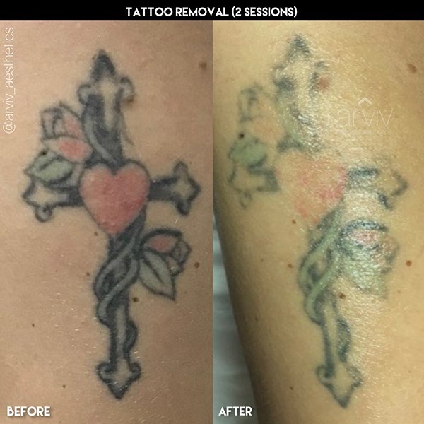tatuaje antes y después 2 laster tattoo before and after 2