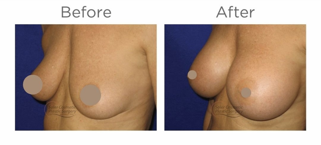 Múltiples mamas Aug - 3 Multiple Breast Aug - 3