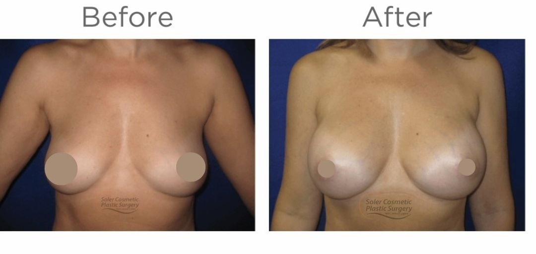 Múltiples mamas Aug - 2 Multiple Breast Aug - 2