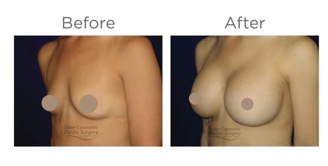 Múltiples mamas Aug - 1 Multiple Breast Aug - 1