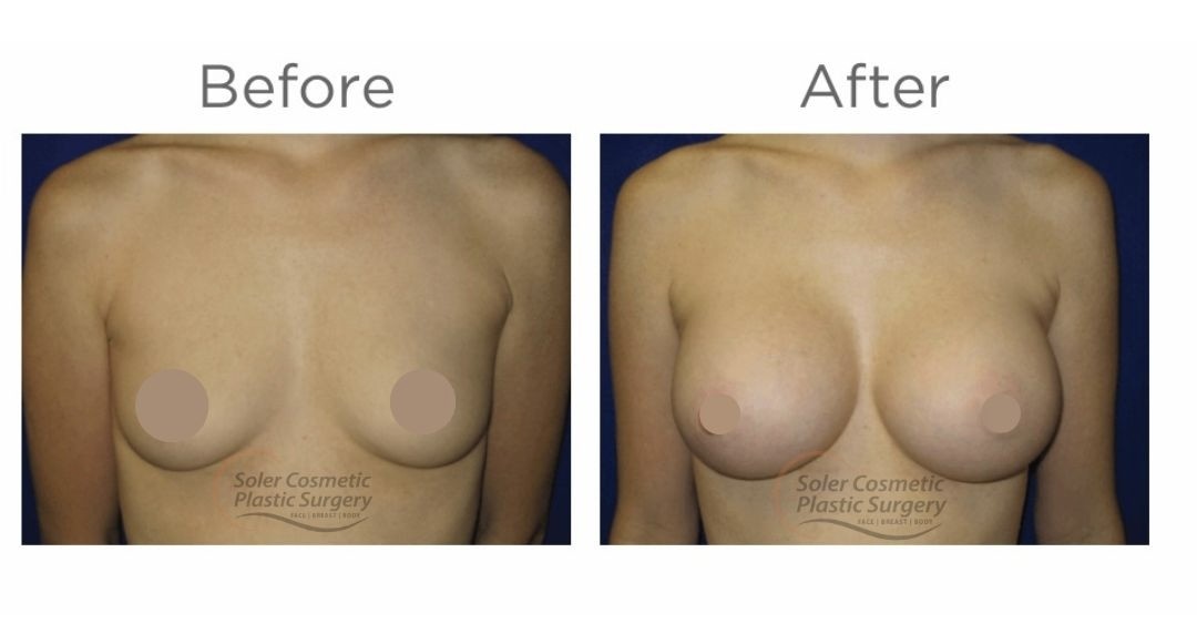 Múltiples mamas Aug - 4 Multiple Breast Aug - 4