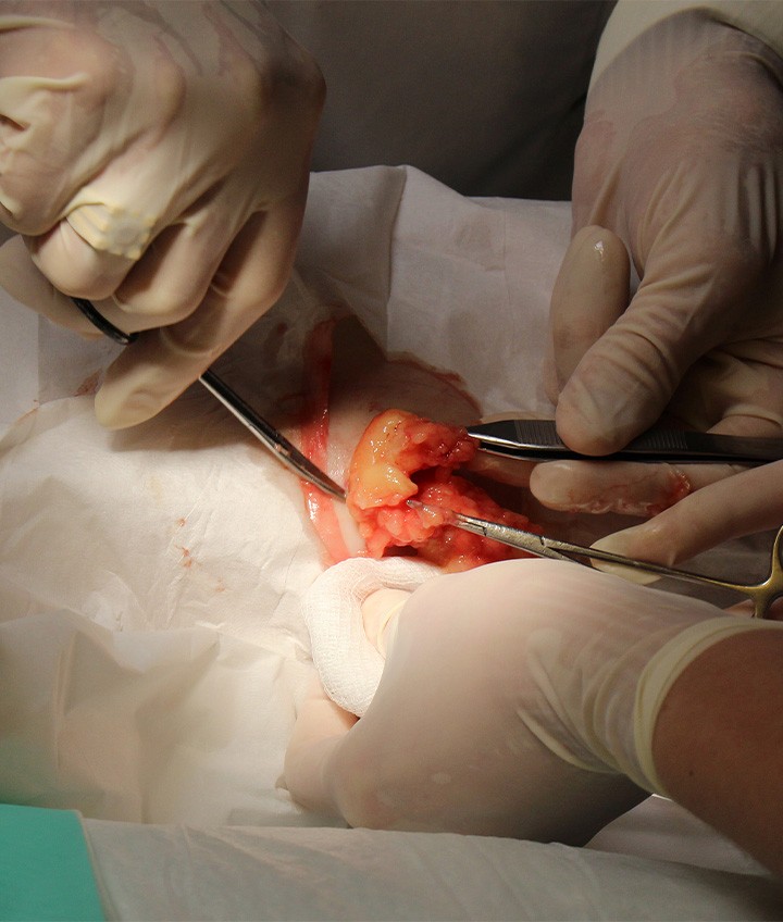 Lipoma Removal Procedure