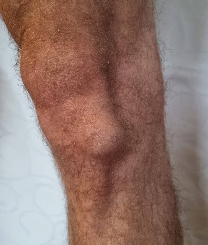 Lipoma on Leg