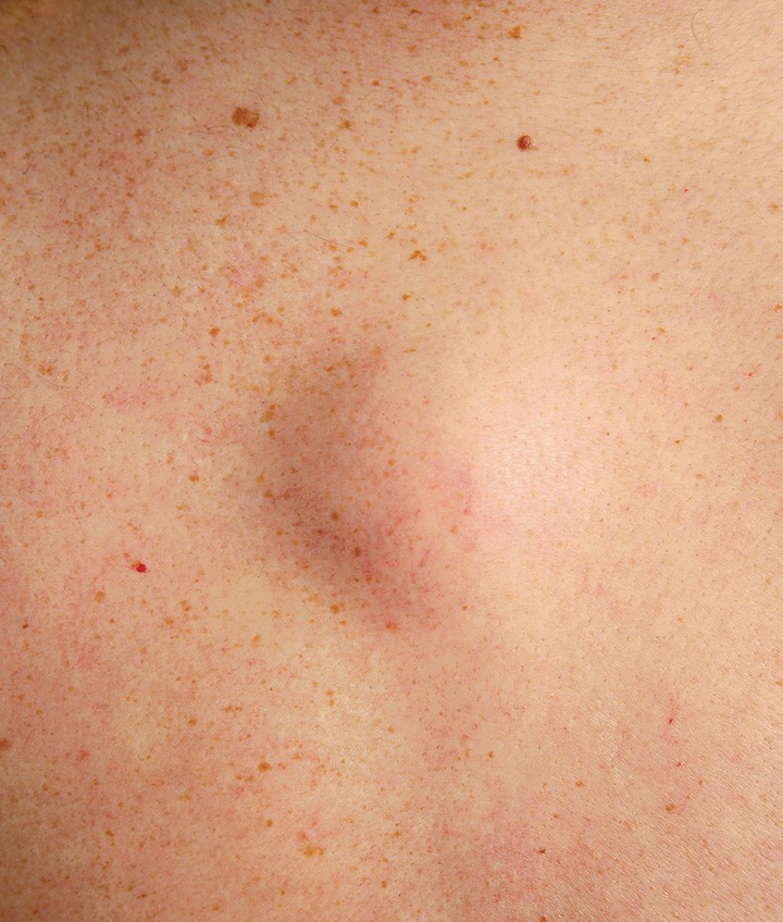 Lipoma