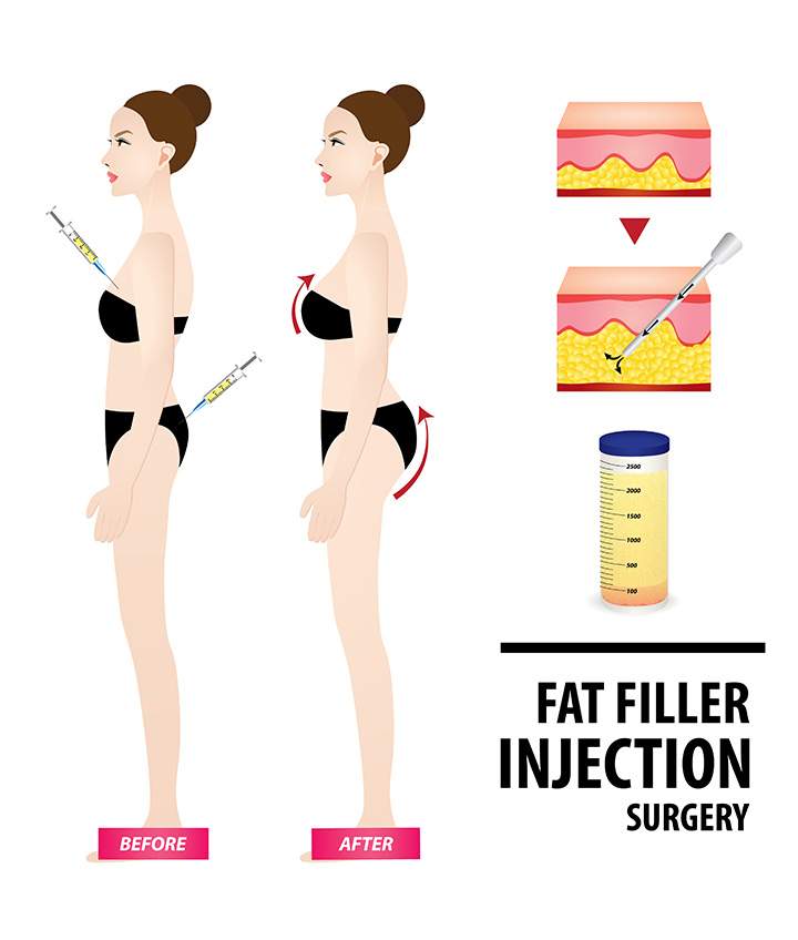 What Is Breast Fat graft