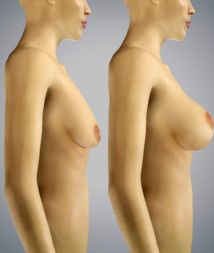 What Is Breast Implant Removal?
